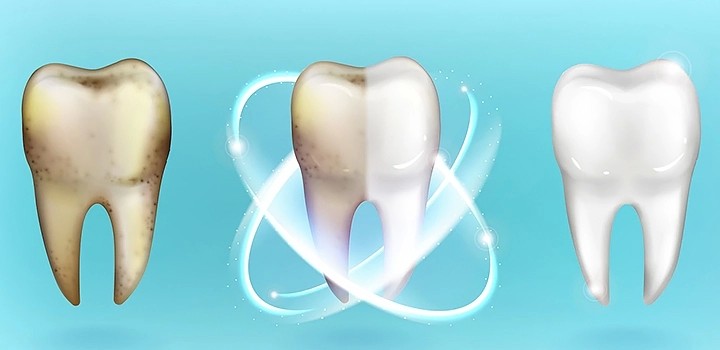 How to Repair Damaged Enamel