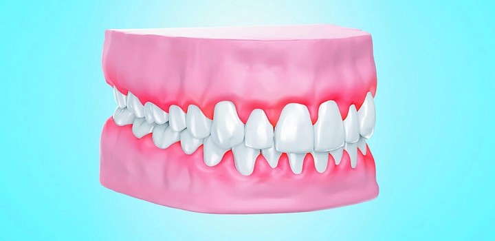 What Causes My Gums To Bleed?