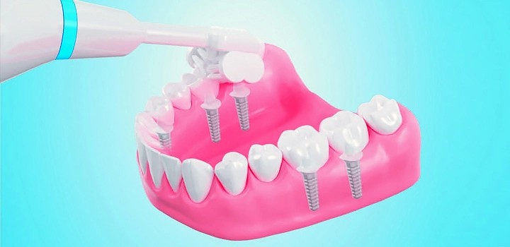 Triple Bristle Expertly Cleans Around Dental Implants