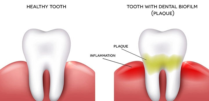 What is Plaque - Best Electric Toothbrush for Plaque Removal