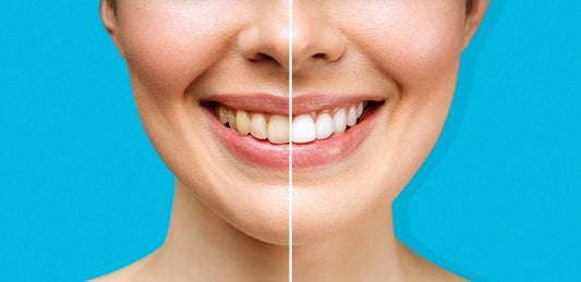 Winning Strategy for a Whiter, Brighter Smile