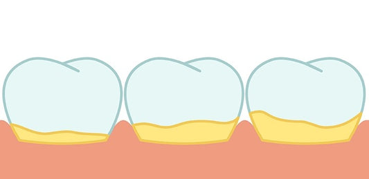Dental Calculus (Tartar): Causes, Prevention, & Removal