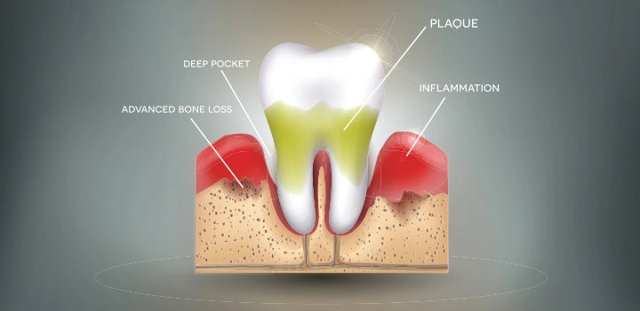 Periodontitis: Symptoms, Home Remedies, & Treatments