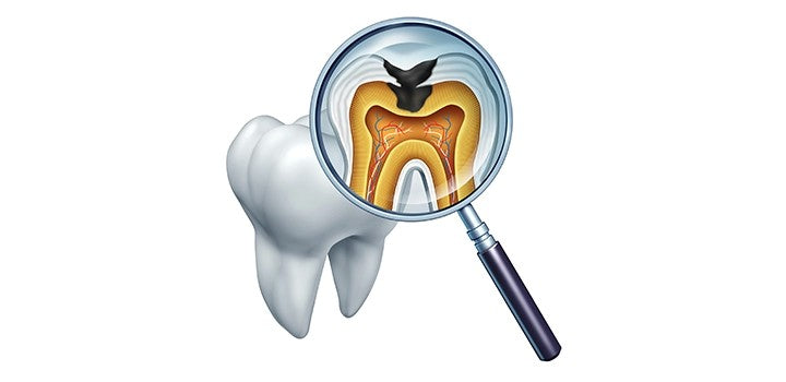 Teeth Cavities: Symptoms, Causes, Prevention & Treatment